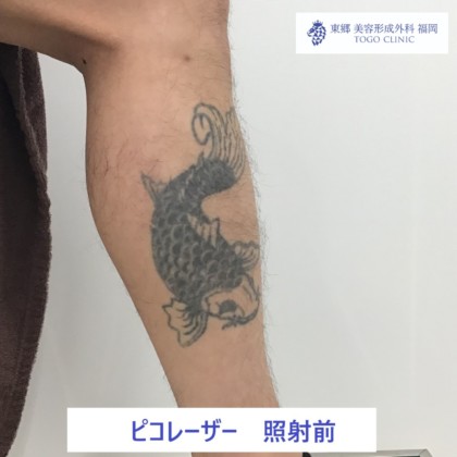タトゥー　刺青　ピコレーザー