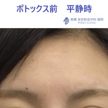 眉間のボトックス注射 東郷美容形成外科 福岡 福岡 博多駅前で美容外科 美容整形なら