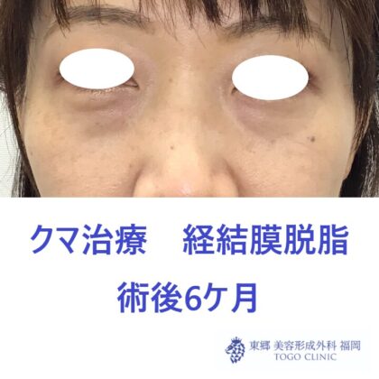 6686スサキアカリ経結膜脱脂術後正面