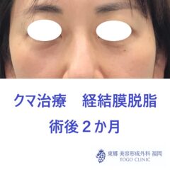 5100フクダヒロミ経結膜脱脂術後