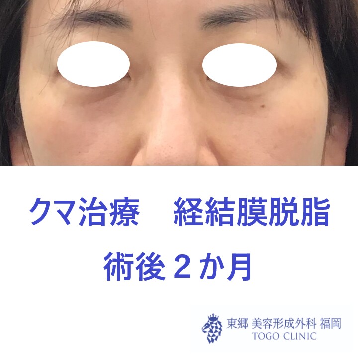 5100フクダヒロミ経結膜脱脂術後