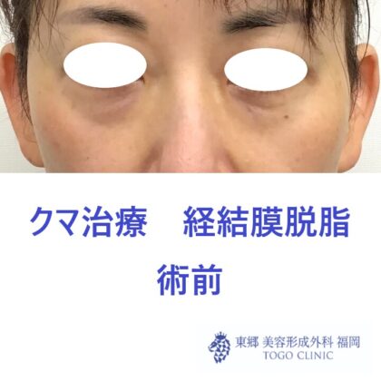 5100フクダヒロミ経結膜脱脂術前