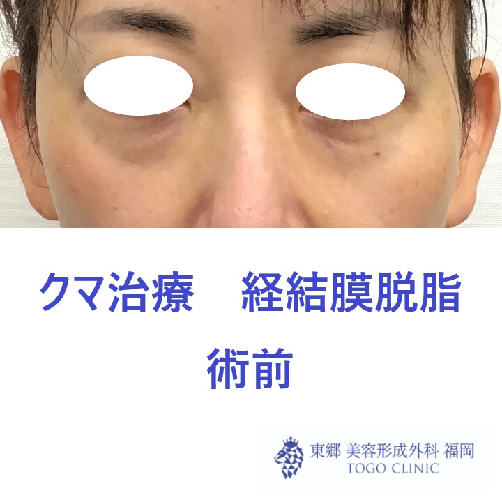 5100フクダヒロミ経結膜脱脂術前