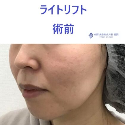 ｵｵﾂﾎﾞﾄﾖﾐ術前 (2)