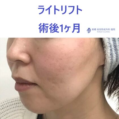 ｵｵﾂﾎﾞﾄﾖﾐ術後 (2)