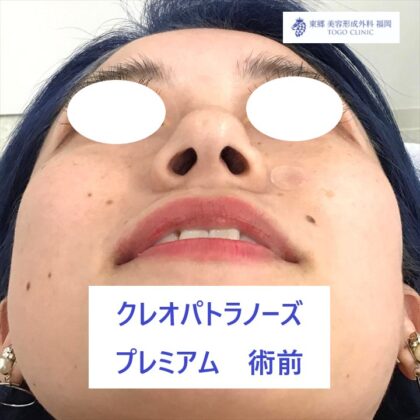 4401　ヒラタナナミ　ＫＰノーズ　術前下_R