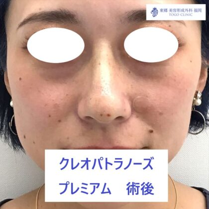 4401　ヒラタナナミ　ＫＰノーズ　術後正面_R