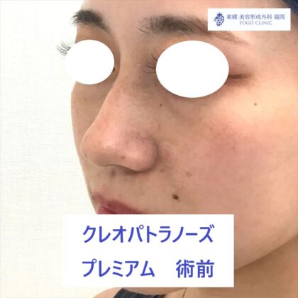 4401　ヒラタナナミ　ＫＰノーズ　術前ななめ_R