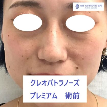 4401　ヒラタナナミ　ＫＰノーズ　術前正面_R