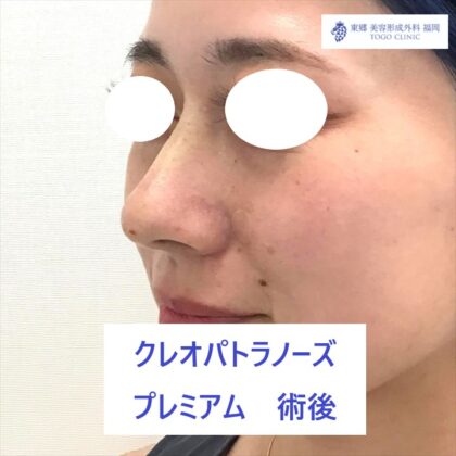 4401　ヒラタナナミ　ＫＰノーズ　術後ななめ_R