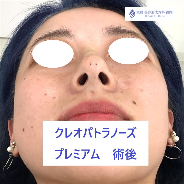 4401　ヒラタナナミ　ＫＰノーズ　術後下_R