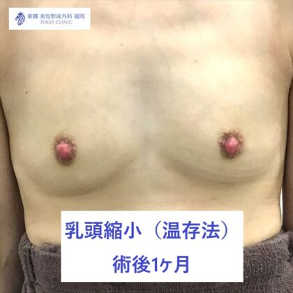 7080シゲナガエリ乳頭縮小　術後正面_R