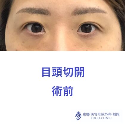 738ハラカワリエ目頭切開　術前正面2_R