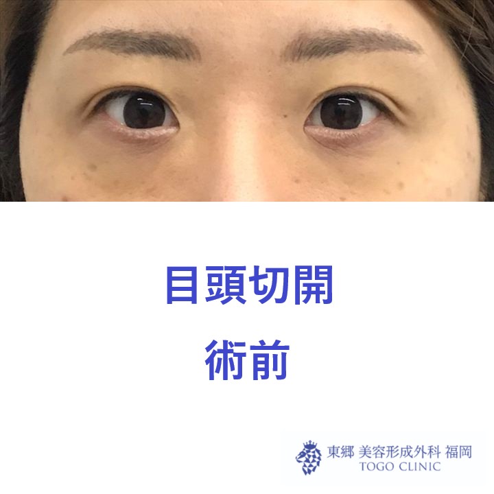 738ハラカワリエ目頭切開　術前正面2_R