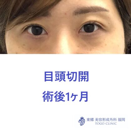 738ハラカワリエ目頭切開　術後正面2_R