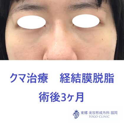 6216ツムラユカリ経結膜脱脂術後