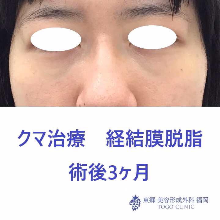 6216ツムラユカリ経結膜脱脂術後