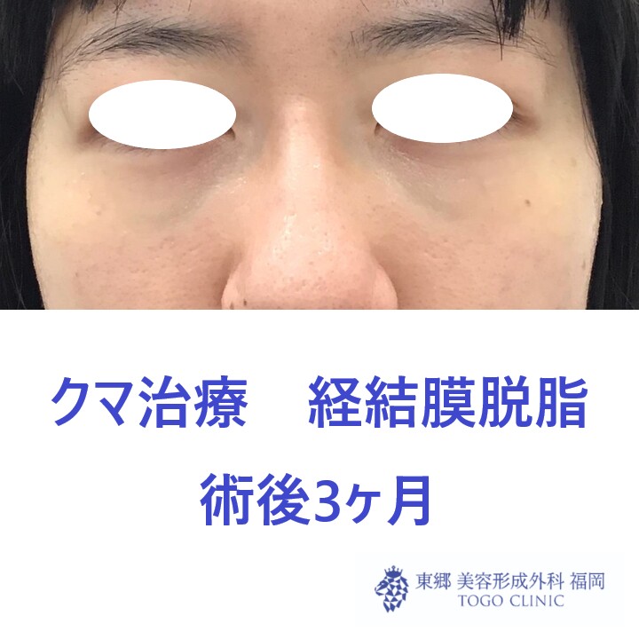 6216ツムラユカリ経結膜脱脂術後