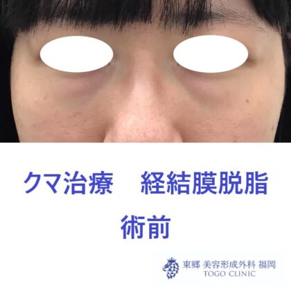 6216ツムラユカリ経結膜脱脂術前