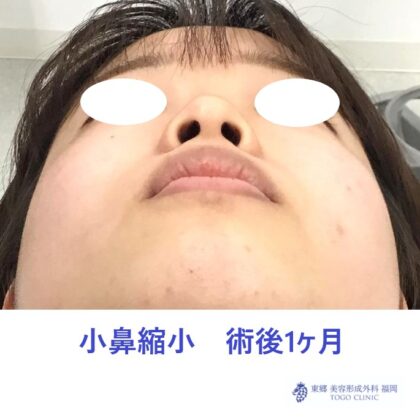 6490スエヨシミユ　小鼻縮小術後下jpeg_R