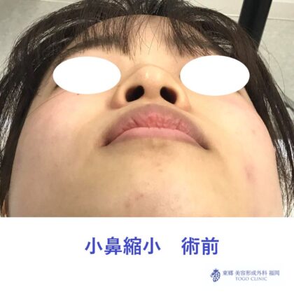 6490スエヨシミユ　小鼻縮小術前下jpeg_R