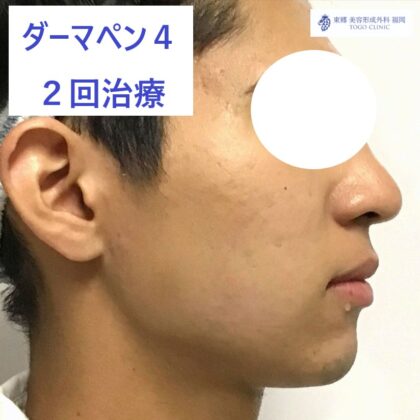 5865ニシミヤスキ　ダーマペン術後横_R