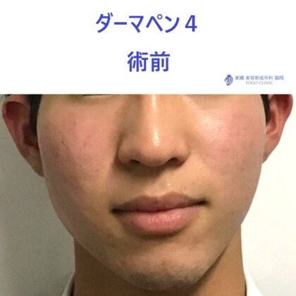 5865ニシミヤスキ ダーマペン術前正面_R