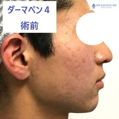 5865ニシミヤスキ　ダーマペン術前横_R