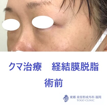 7188ウチノヒロミ経結膜脱脂術前斜め