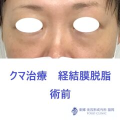 7188ウチノヒロミ経結膜脱脂術前正面