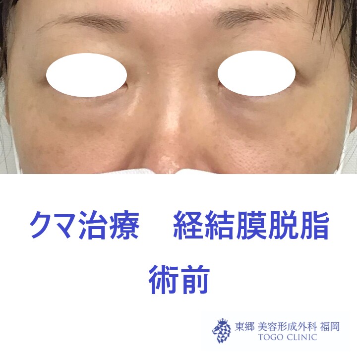 7188ウチノヒロミ経結膜脱脂術前正面