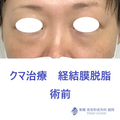 7188ウチノヒロミ経結膜脱脂術前正面