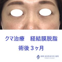 7188ウチノヒロミ経結膜脱脂術後正面