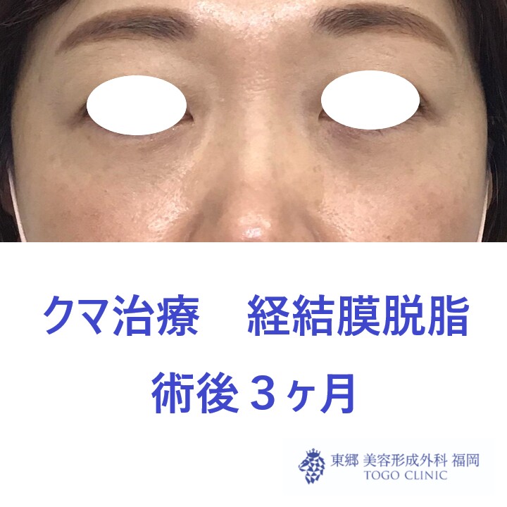 7188ウチノヒロミ経結膜脱脂術後正面