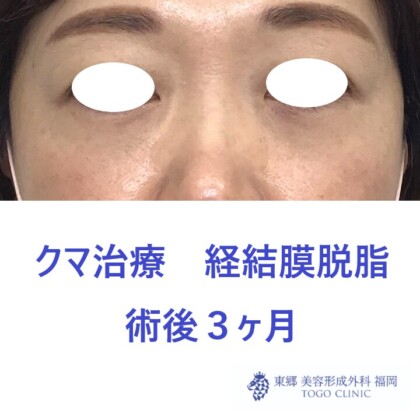 7188ウチノヒロミ経結膜脱脂術後正面