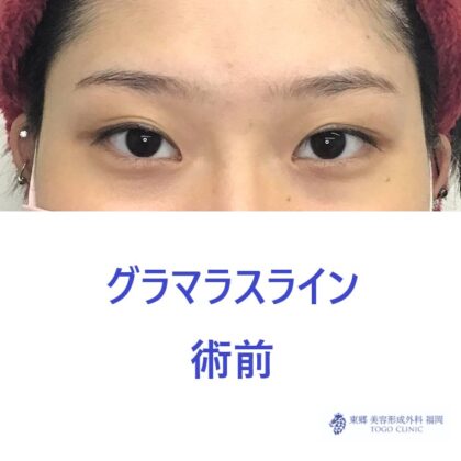 7248タナベチナツ　グラマラスライン術前_R