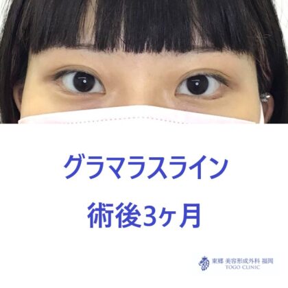 7248タナベチナツ　グラマラスライン術後_R