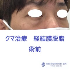 8162ナカムラヤスヒサ経結膜脱脂術前斜め