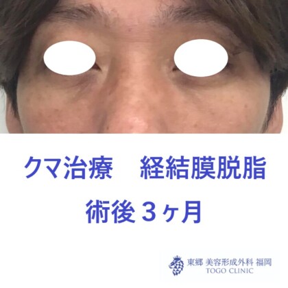 8162ナカムラヤスヒサ経結膜脱脂術後
