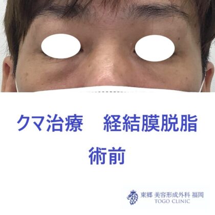 8162ナカムラヤスヒサ経結膜脱脂術前