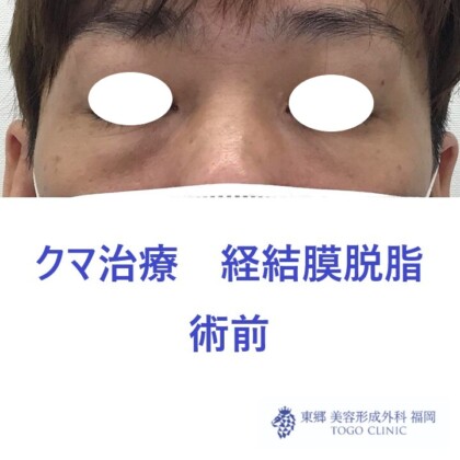 8162ナカムラヤスヒサ経結膜脱脂術前