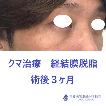 8162ナカムラヤスヒサ経結膜脱脂術後斜め