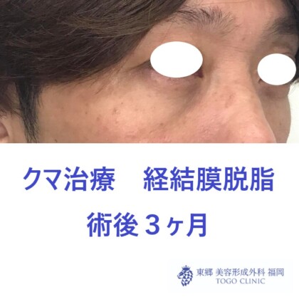 8162ナカムラヤスヒサ経結膜脱脂術後斜め
