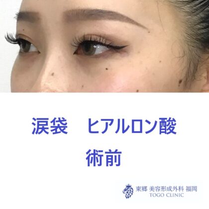9321タナカラン涙袋HA術前斜め