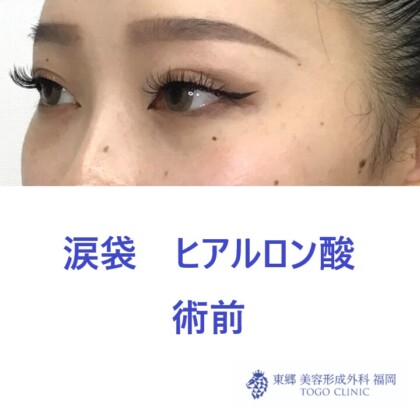 9321タナカラン涙袋HA術前斜め