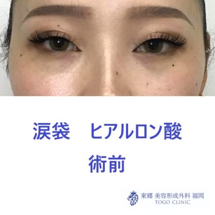 9321タナカラン涙袋HA術前正面