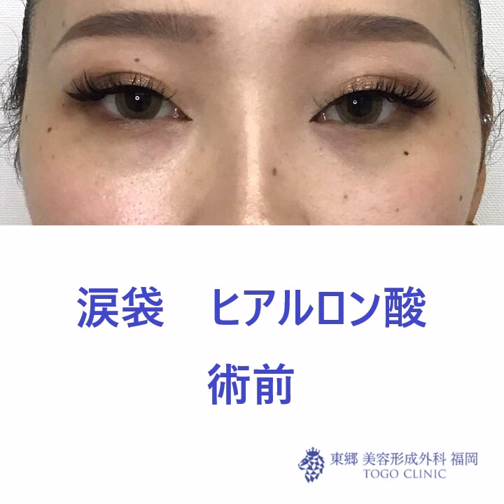 9321タナカラン涙袋HA術前正面