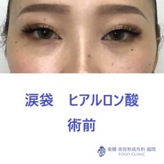 9321タナカラン涙袋HA術前正面