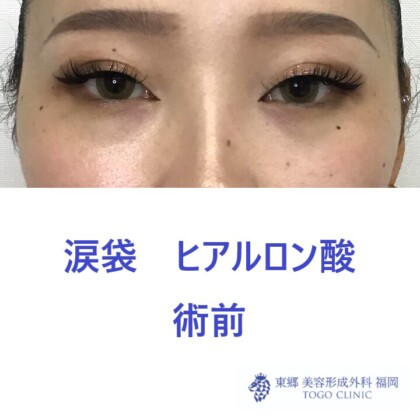 9321タナカラン涙袋HA術前正面