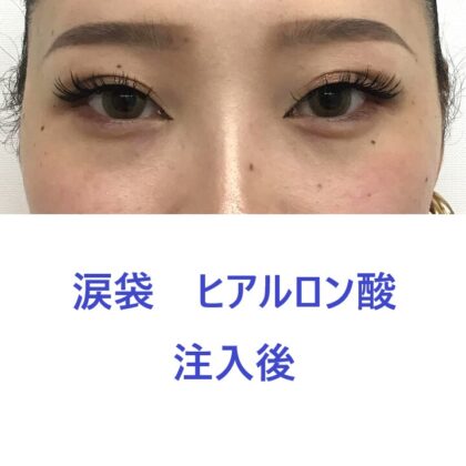 9321タナカラン涙袋HA術後正面